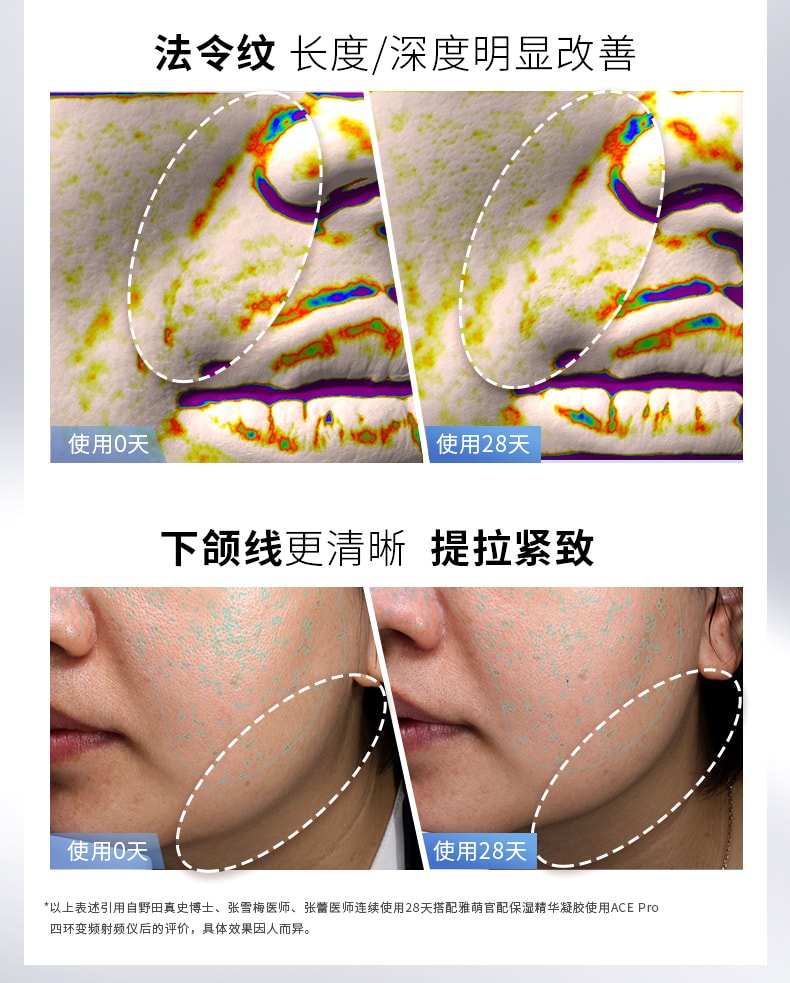 【日本直邮】YAMAN雅萌 ACE PRO 日本本土版 家用脸部红光四环变频射频美容仪 1台