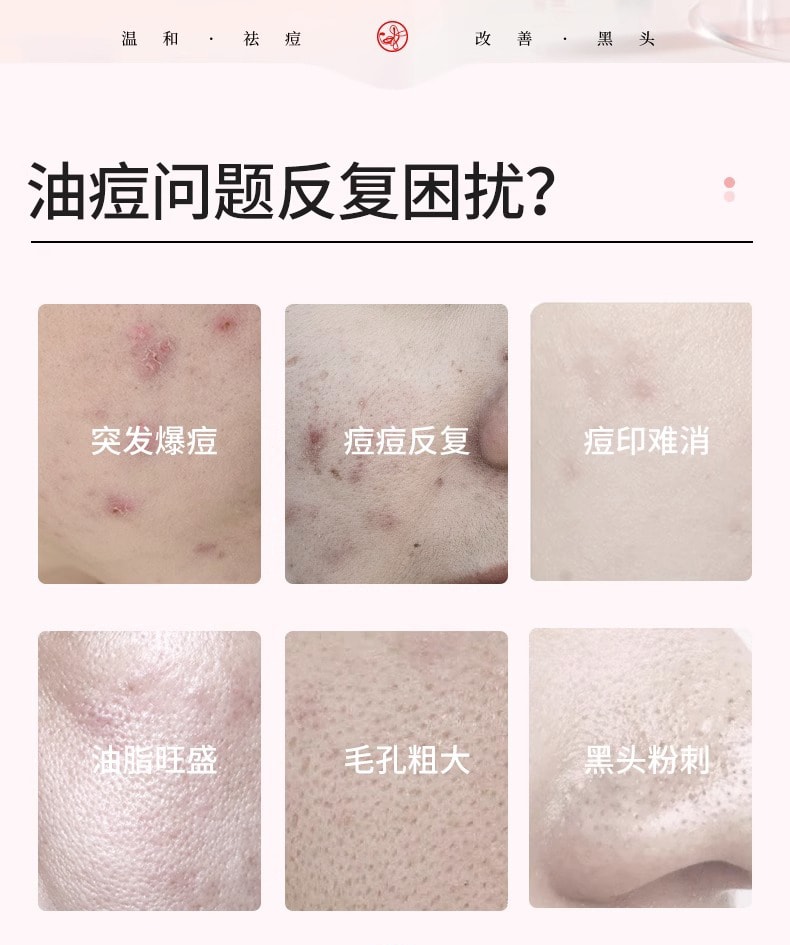 【中國直郵】 歌寶蓮 15%壬二酸祛痘凝膠 去黑頭痘印 收縮毛孔粉刺 30g/支