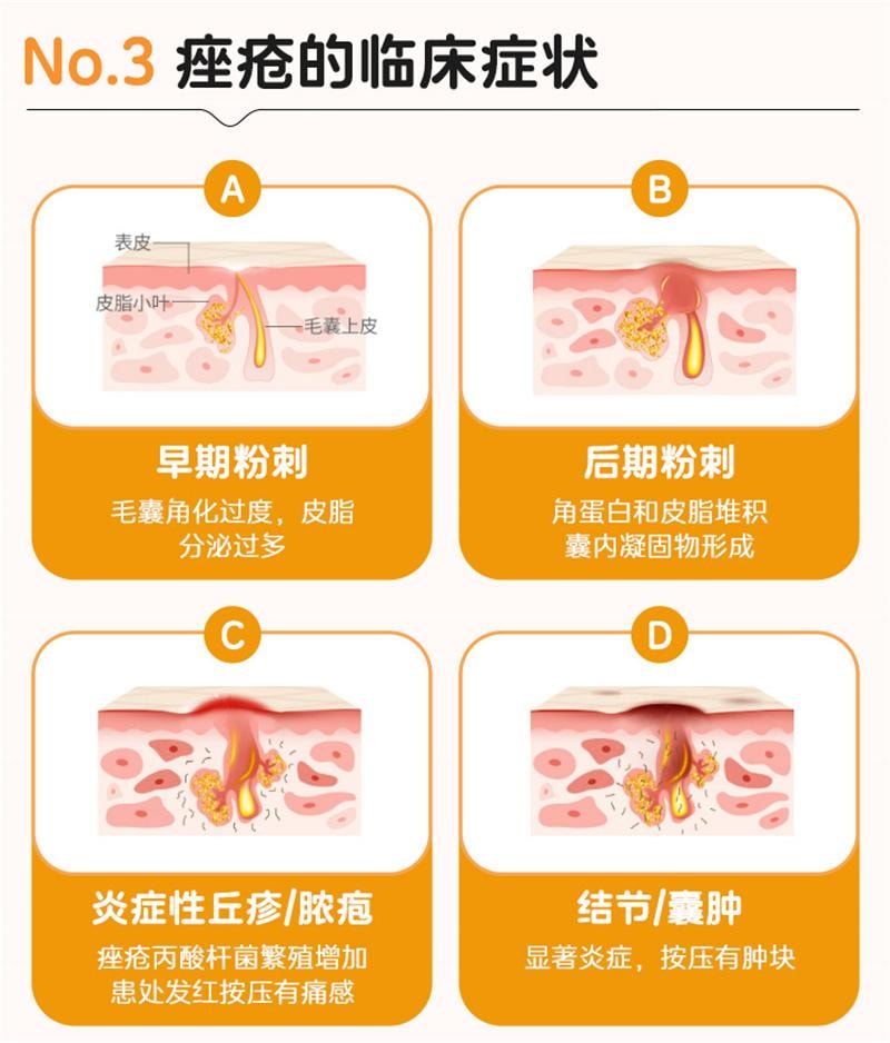 【中国直邮】 美满 盐酸米诺环素 胶囊痤疮 毛囊炎 抗菌消炎 20粒
