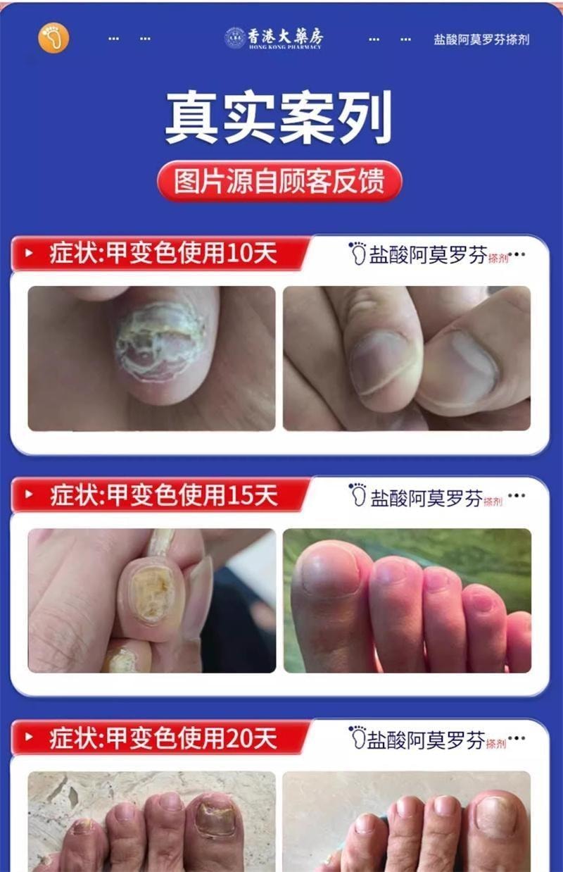 【中國直郵】 香港大藥房 鹽酸阿莫羅芬搽劑 灰指甲專用藥腳氣甲癬甲真菌病 30ml/盒(養成好甲)