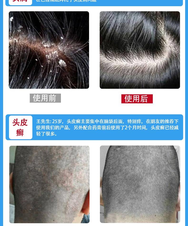  祥医堂 煤焦油抑菌洗液 抗皮脂溢出 改善止痒头皮控油去屑神器洗发水 60ml/盒