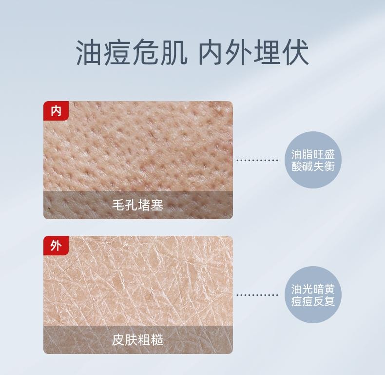 【中國直郵】 軍獻 精華祛痘膏25g 去閉口粉刺紅腫油痘肌