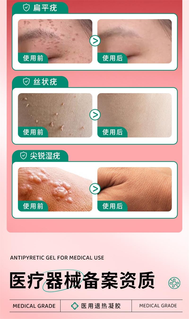 【中国直邮】 北京同仁堂 扁平疣软膏 医用去疣神器去除丝状疣瘊小肉粒一抹灵无忧祛疣型凝胶 20g
