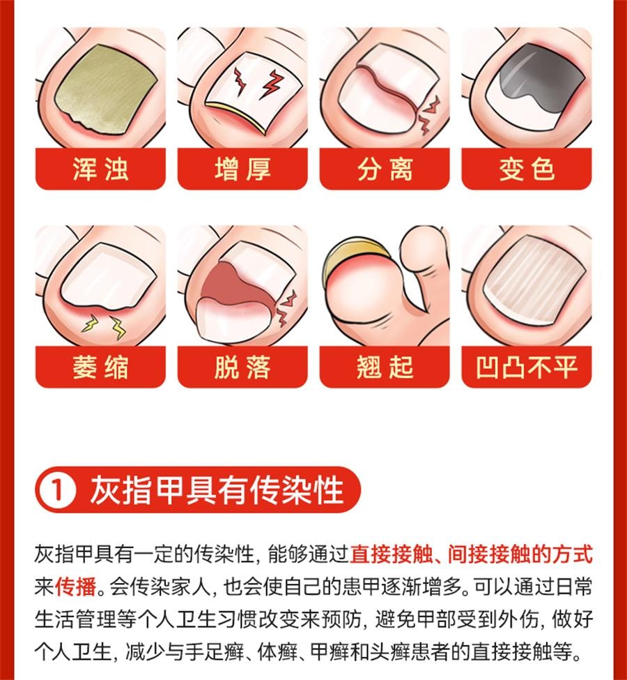 【中国直邮】 太平 硝酸咪康唑乳膏 治疗灰指甲专用药甲硝酸咪康唑乳膏烂脚丫10g/盒