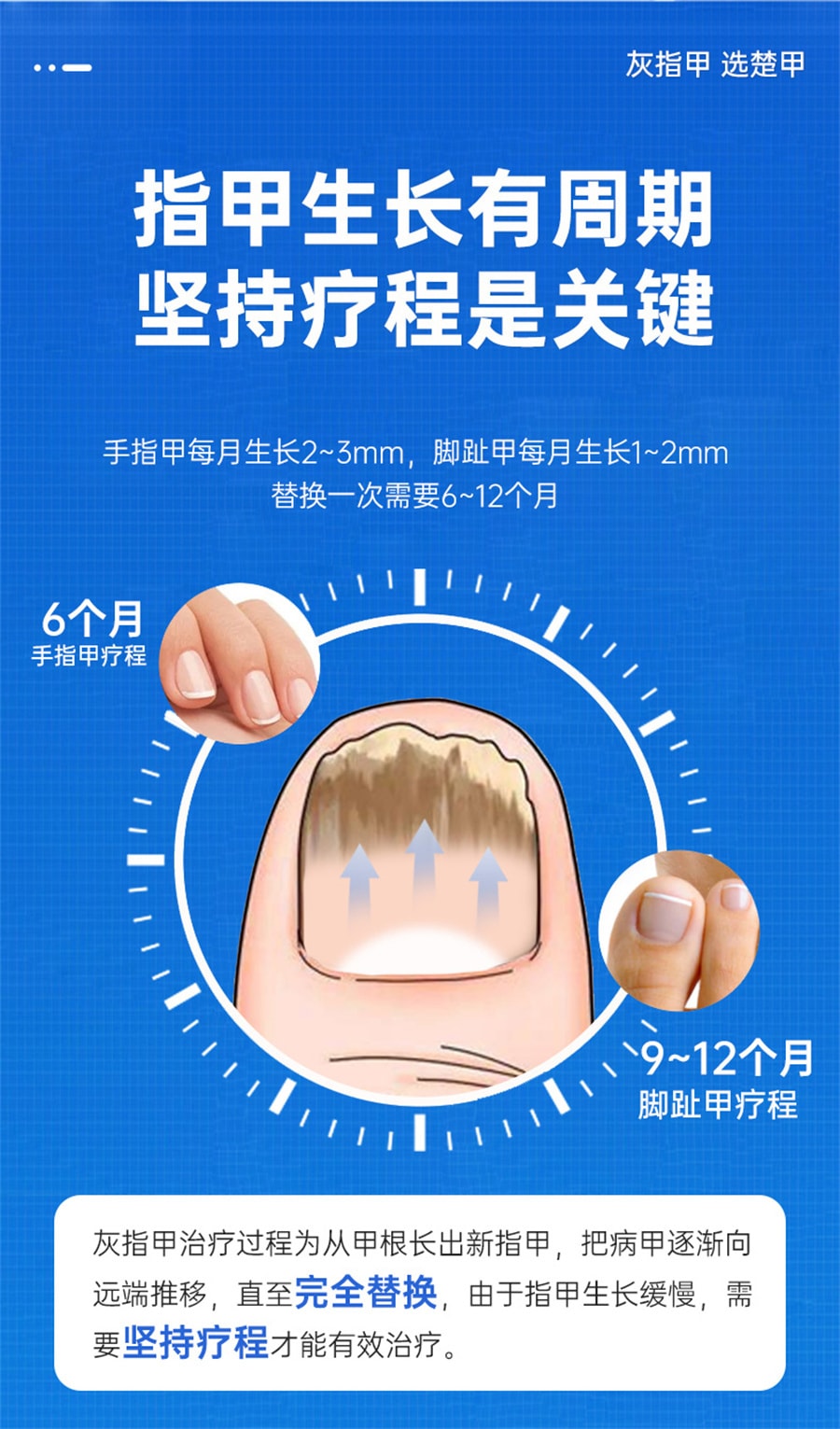 【中国直邮】楚甲 盐酸阿莫罗芬搽剂 灰指甲正品治疗脚气甲癣  1.5ml/盒