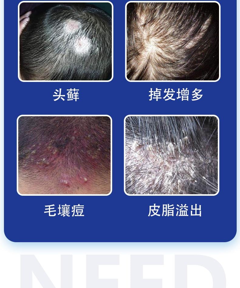 【中国直邮】 祥医堂 苦参碱洗发水 含碱pca锌洗发水 洗头去屑止痒苦渗减正品 110ml/盒