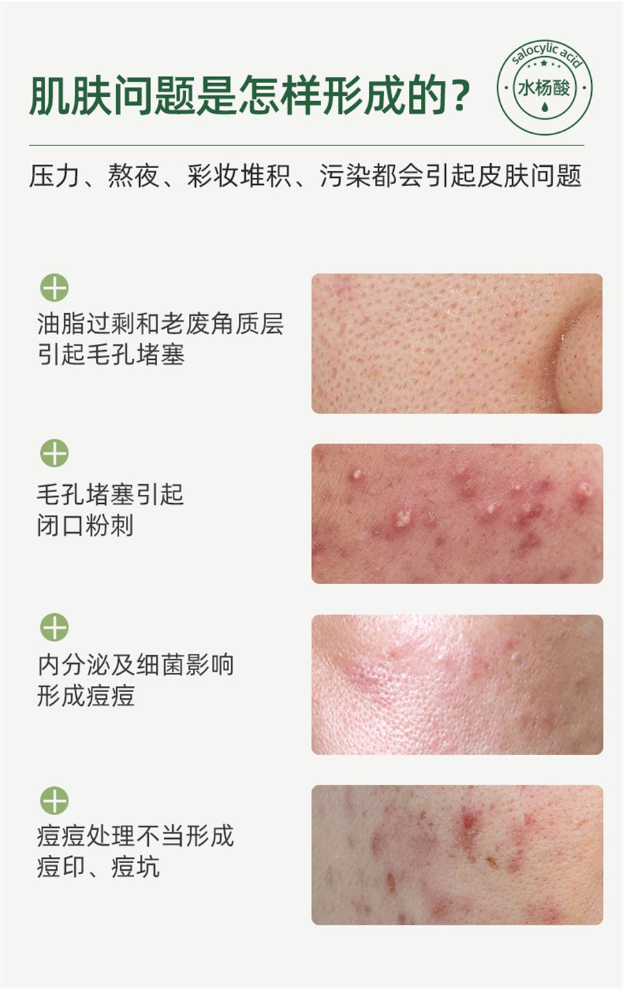 【中國直郵】Geboline/歌寶蓮 水楊酸祛痘收縮毛孔粗大修復淡化痘印酸刷去閉口黑頭粉刺凝膠精華 30g
