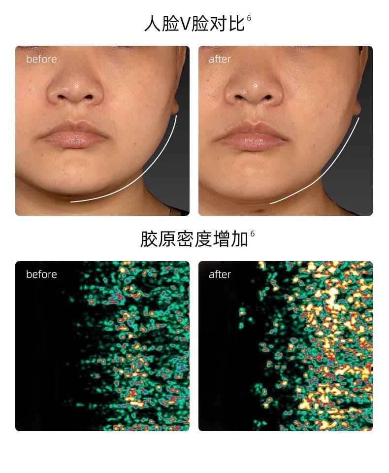 JOVS 超膜刀肌提美容儀家用臉部提拉緊緻抗老去法令紋V臉神器旗艦版 1件