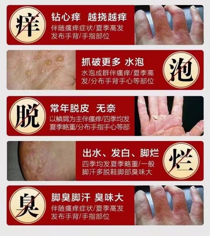 【中國直郵】 嚴和 汗疹草本乳膏 小水泡手癢皮膚搔癢蚊蟲叮咬抑菌止癢膏 15g/盒