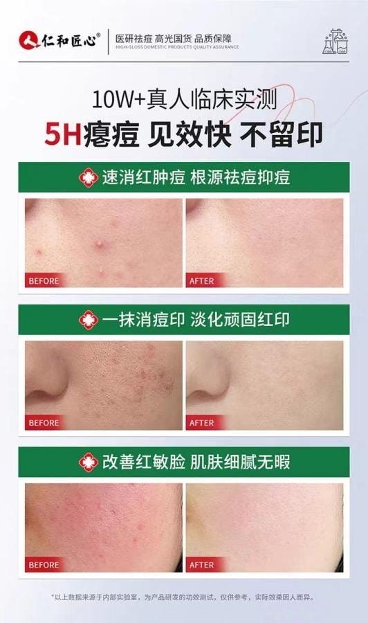 【中國直郵】 仁和 任二酸草本祛痘膏30g 1盒裝 祛痘印修復膏淡化去痘印坑面霜男女通用 博主推薦