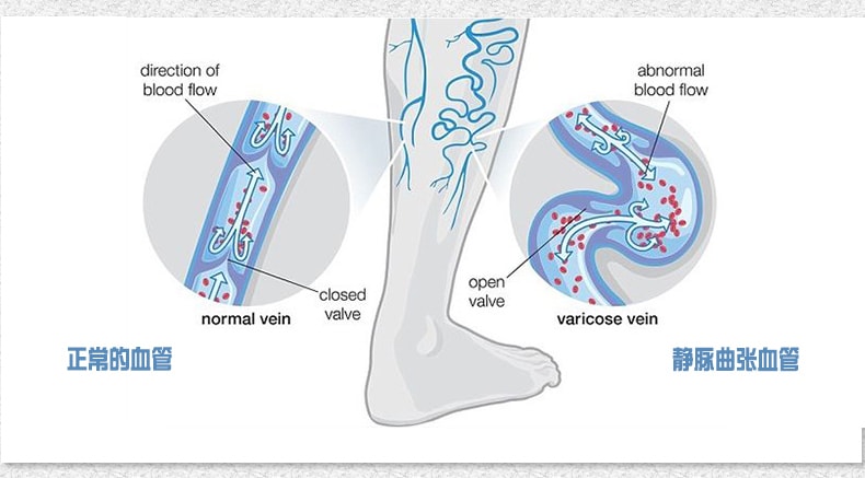 【中国直邮】正大 静脉曲张弹力袜 三级长筒九分款M码医用女男医疗压力治疗型小腿防筋脉血栓