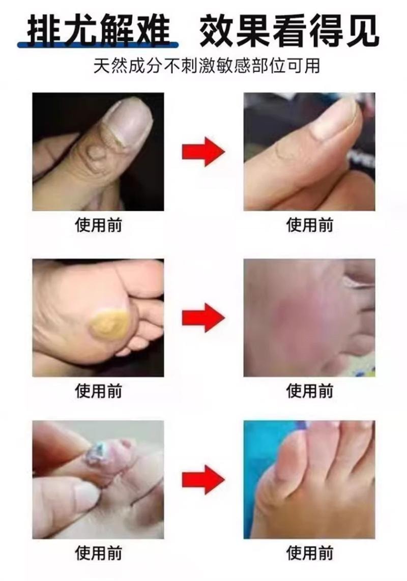 祥医堂 鬼臼毒素酊10ml/盒 去鸡眼尖锐丝状扁平克疣抑菌外用