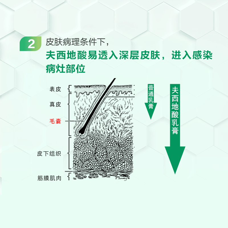 【中國直郵】奧絡 夫西地酸乳膏祛痘2%軟膏甲溝炎慢性濕疹皮膚病 10g/支