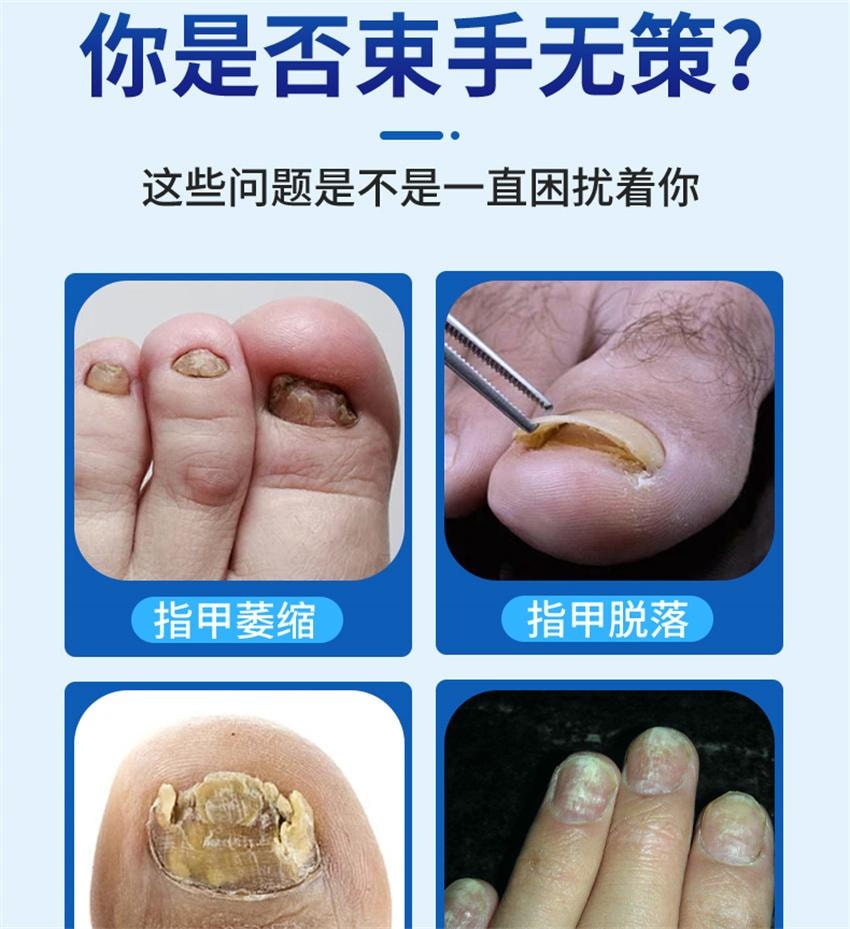 【中国直邮】 祥医堂 阿莫灰甲抑菌擦剂 修复灰指甲脱甲液 阿莫罗芬搽剂灰指甲正品 5ml/盒