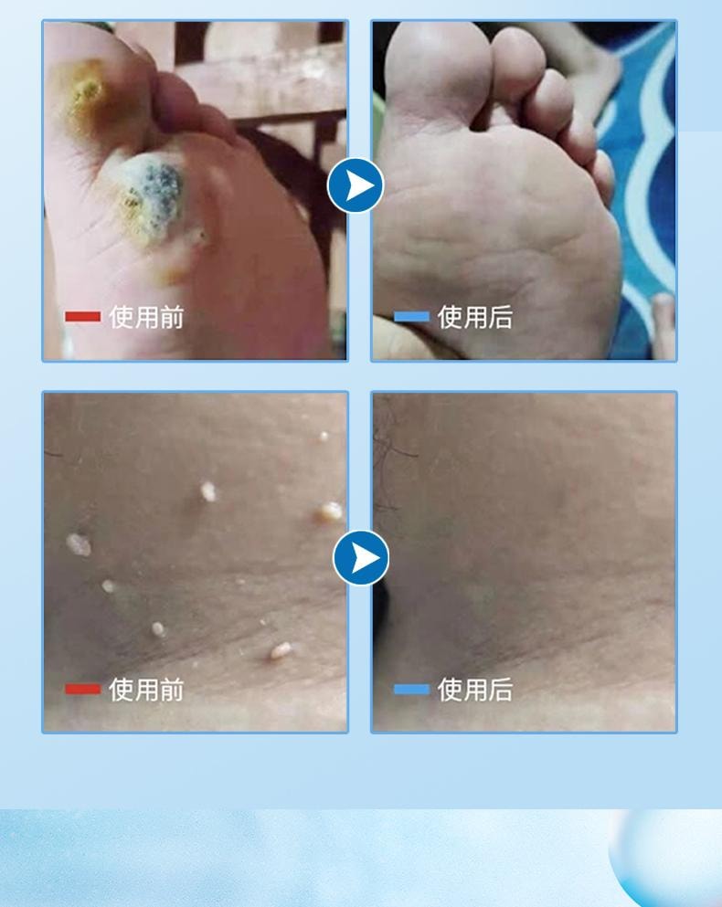 【中國直效郵件】 祥醫堂 鬼臼毒素酊 男女私處尖銳濕尤外用抑菌液 輕鬆應付各種尤痕包疹問題 10ml/盒
