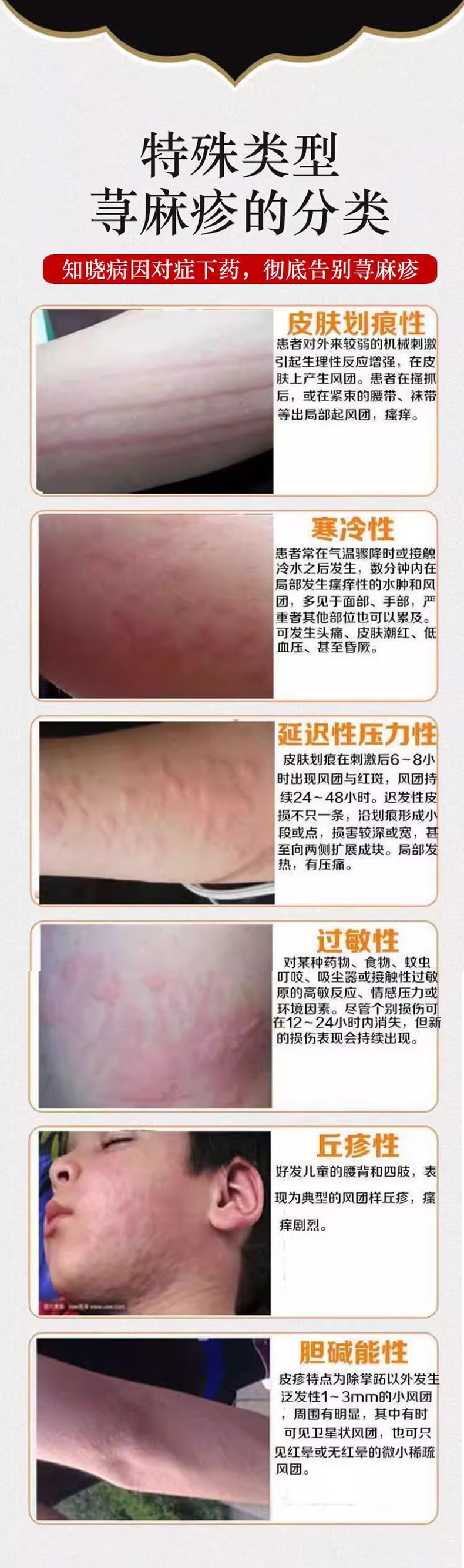  東瑞製藥 鹽酸西替利嗪片 鼻炎蕁麻疹抗過敏 12片/盒