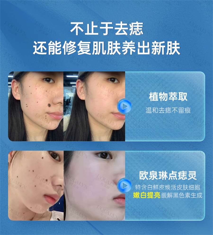 【中国直邮】欧泉琳 点痣膏无痕脸部去痣淡斑神器点痣笔非药水点斑美容专用 5g/瓶+5ml/瓶