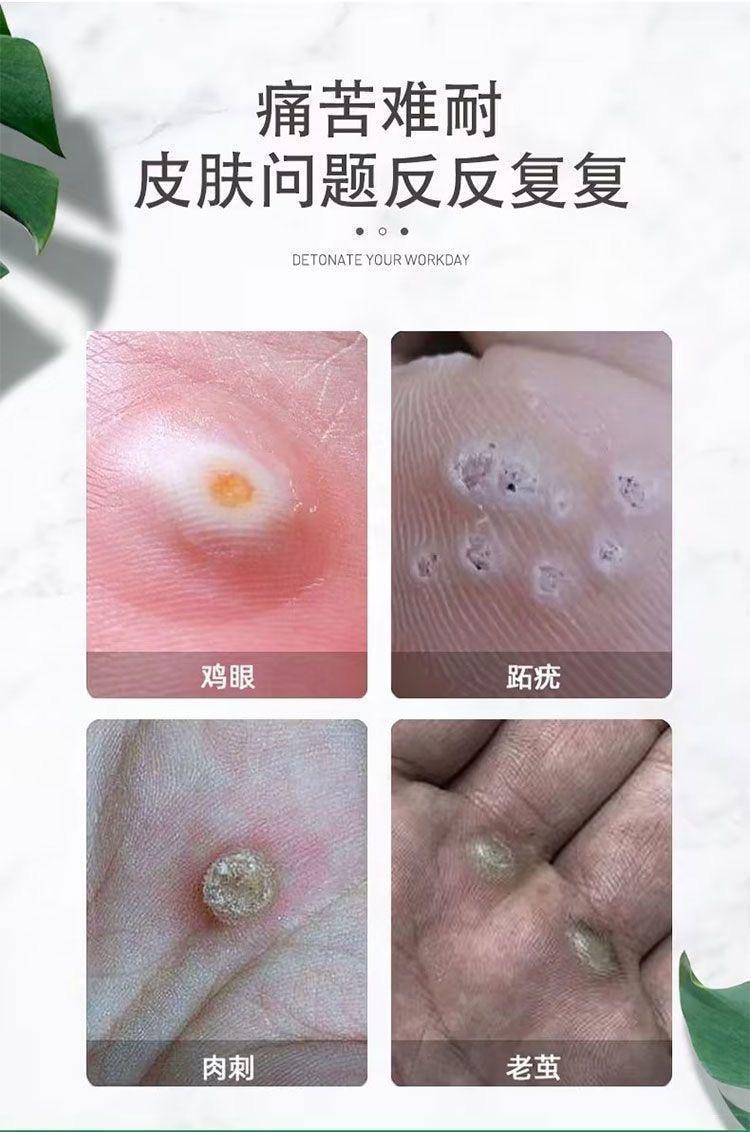 云南本草 鸡眼膏抑菌膏去鸡眼膏跖疣瘊子肉刺老茧除鸡眼贴 20g/盒(建议拍6支)