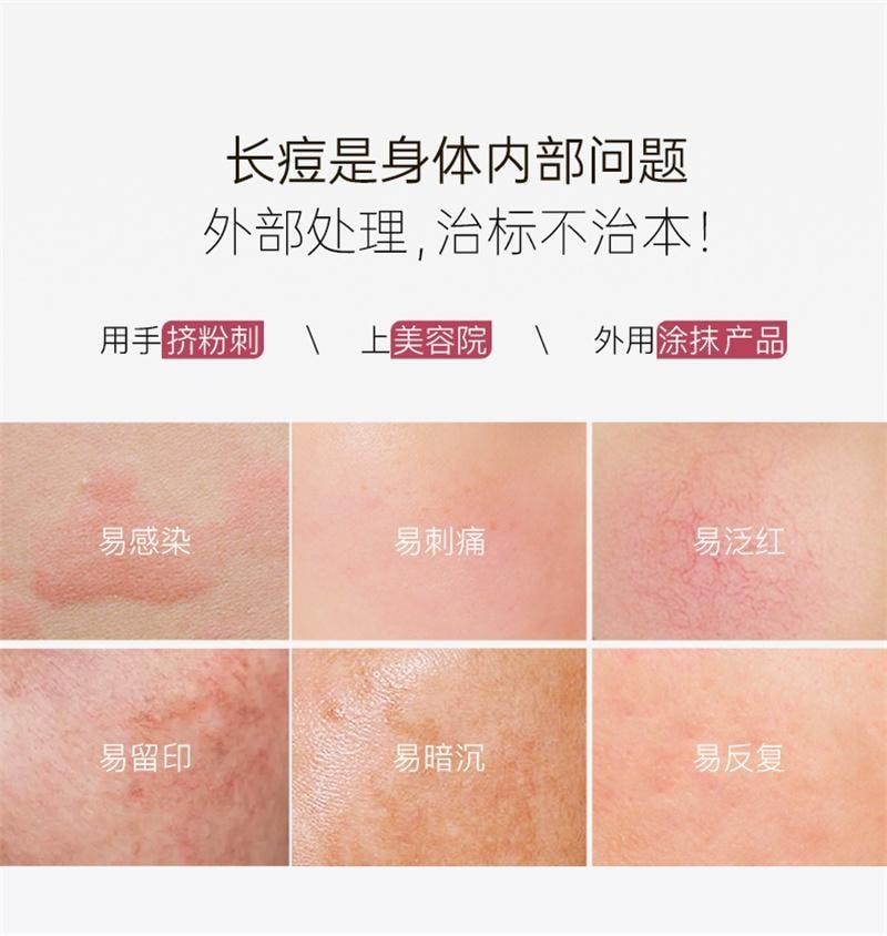 【中国直邮】 碧维斯 净痘胶囊 男女控油净痘粉刺淡化痘印收缩毛孔 60粒/盒