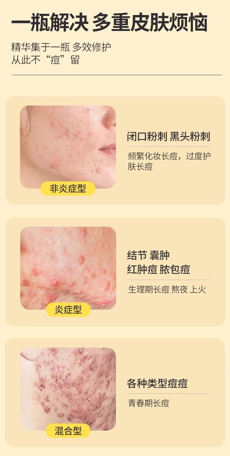 【中国直邮】 会美 七味姜黄搽剂 苗方中药 快速祛痘 闭口粉刺 痤疮脂溢性皮炎 10ml/盒