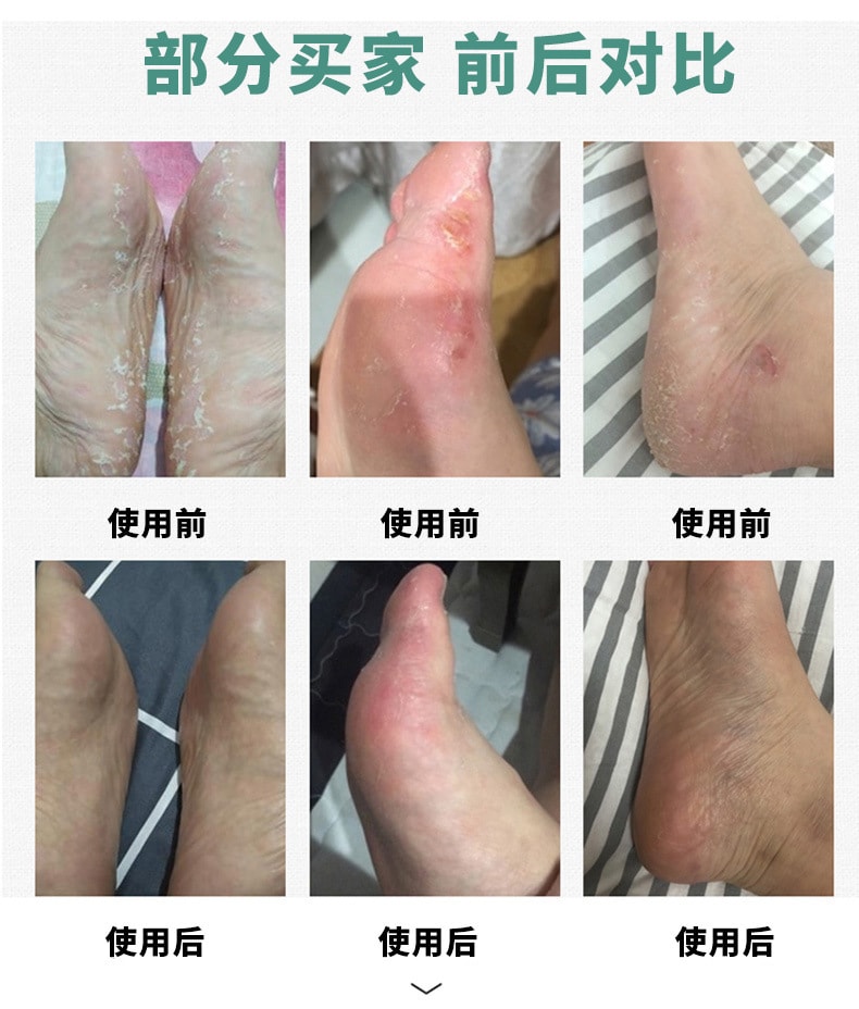 【中國直郵】嚴和 狼毒皮膚軟膏20g/支 外用抑菌止癢藥膏