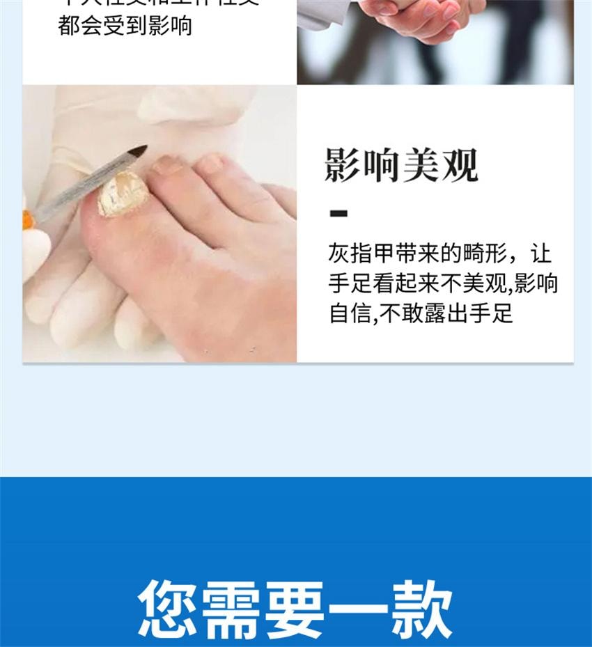 【中国直邮】 祥医堂 阿莫灰甲抑菌擦剂 修复灰指甲脱甲液 阿莫罗芬搽剂灰指甲正品 5ml/盒