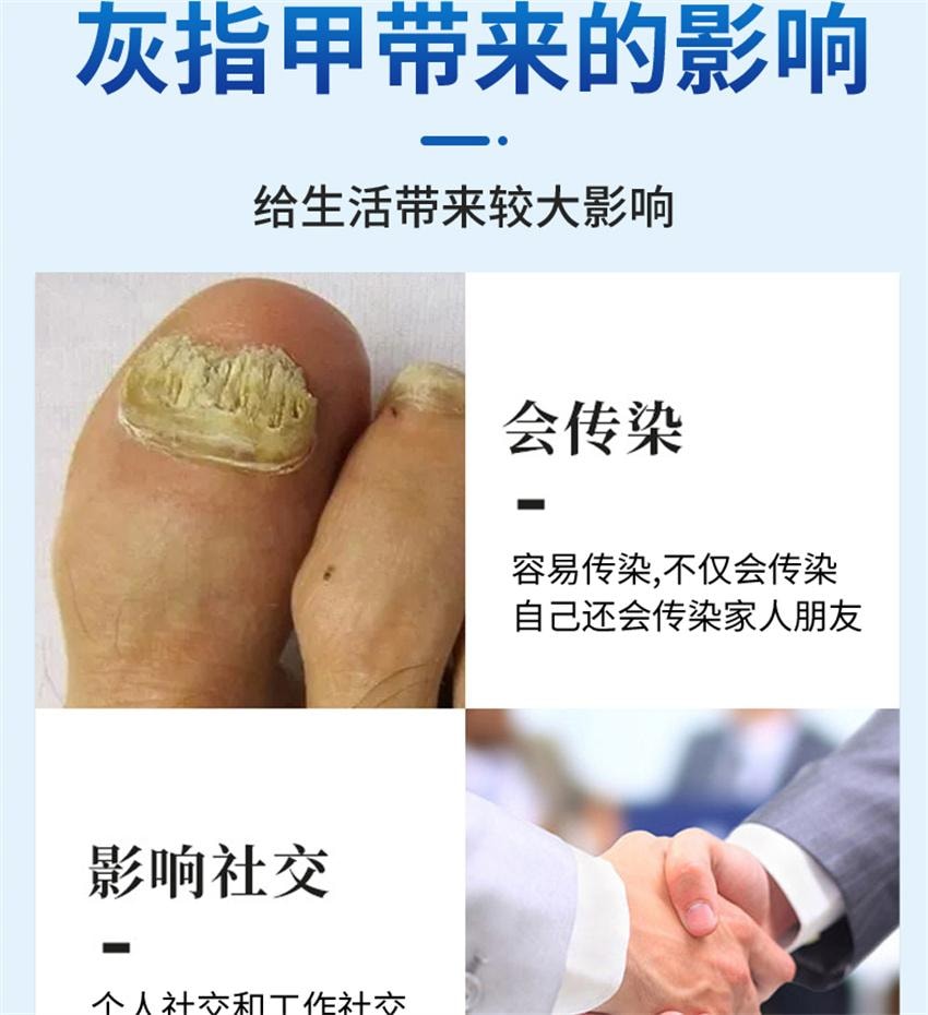 【中国直邮】 祥医堂 阿莫灰甲抑菌擦剂 修复灰指甲脱甲液 阿莫罗芬搽剂灰指甲正品 5ml/盒
