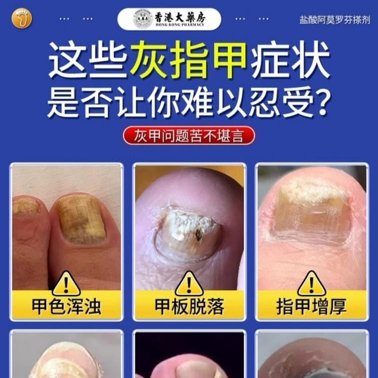 【中國直郵】 香港大藥房 鹽酸阿莫羅芬搽劑 灰指甲專用藥腳氣甲癬甲真菌病 30ml/盒(養成好甲)
