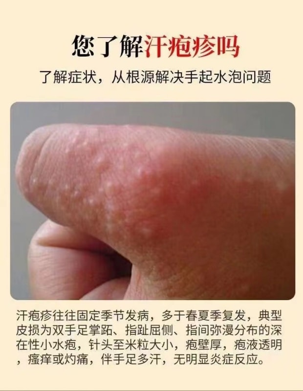 【中國直郵】 嚴和 汗疹草本乳膏 小水泡手癢皮膚搔癢蚊蟲叮咬抑菌止癢膏 15g/盒