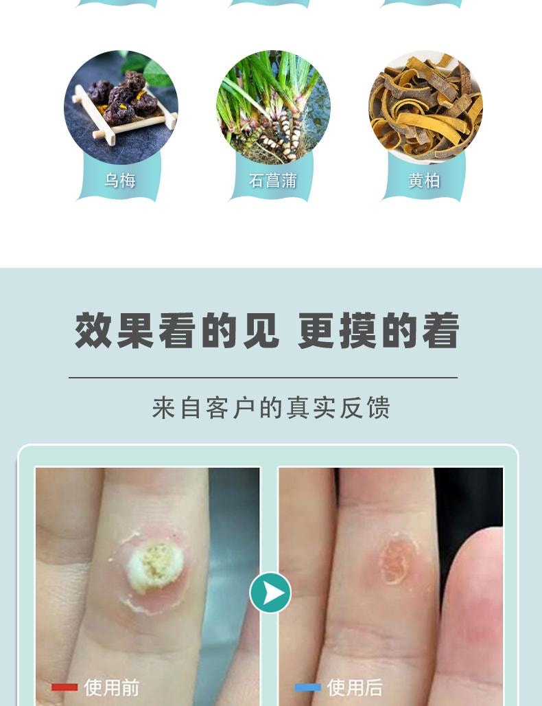 【中国直邮】 祥医堂 疣清宁 扁平尤乳膏 去尤瘊小肉粒神器疣膏 轻松应对各种疣痕问题 20g/盒