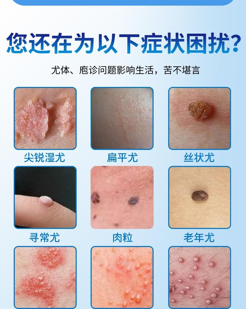 【中國直效郵件】 祥醫堂 鬼臼毒素酊 男女私處尖銳濕尤外用抑菌液 輕鬆應付各種尤痕包疹問題 10ml/盒