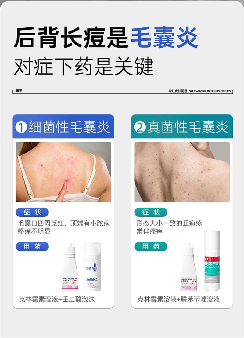 【中国直邮】 丽芙 克林霉素磷酸酯外用溶液 毛囊炎前胸后背祛痘喷雾背部祛痘除螨 30ml