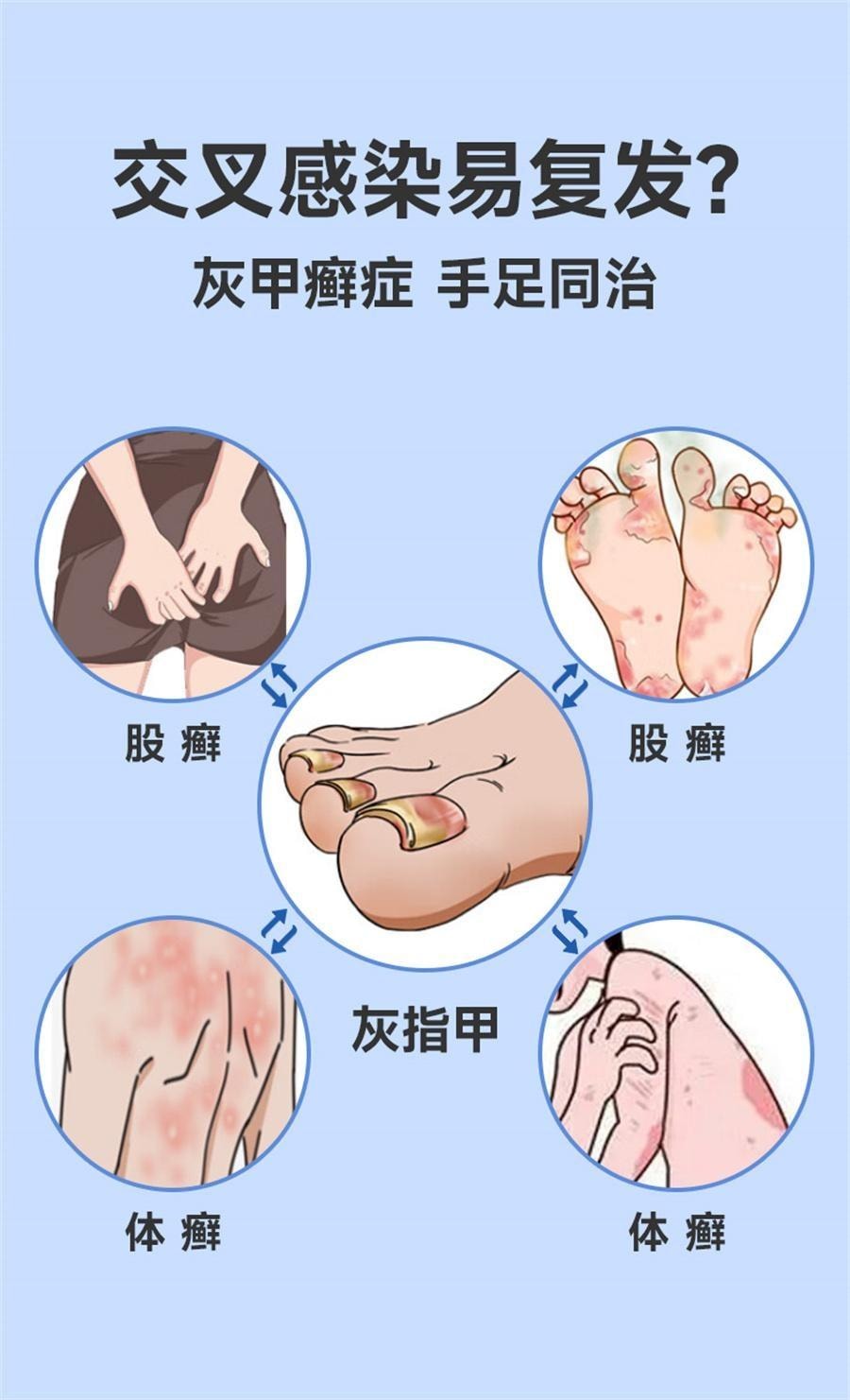 【中国直邮】 恒医森 环吡酮胺乳膏 治疗灰指甲专用药环比癣症真菌脚气止痒脱皮杀菌药水 20g/支