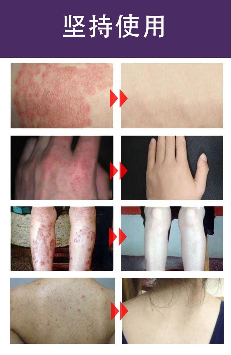 【中國直郵】 姚本仁 苗鋪膚癢靈 皮膚搔癢濕癢止癢外用軟膏乳膏 20g/盒