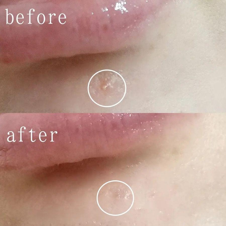 【日本直郵】 日本 SHISEIDO 資生堂 IHADA皮膚祛痘膏 16g