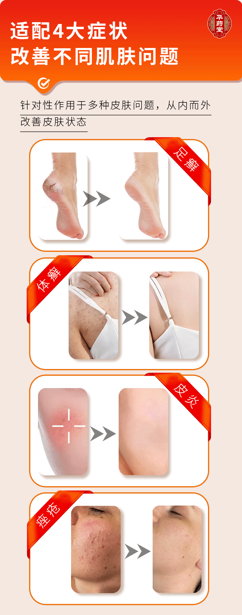 華藥堂 百癬濕毒清錠 0.31g*72片 手癬 腳癬 體癬 花斑癬 過敏性皮膚炎 痤瘡 消腫止痛止癢