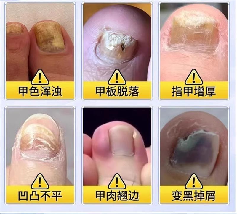 【中國直郵】 香港大藥房 鹽酸阿莫羅芬搽劑 灰指甲專用藥腳氣甲癬甲真菌病 30ml/盒(養成好甲)