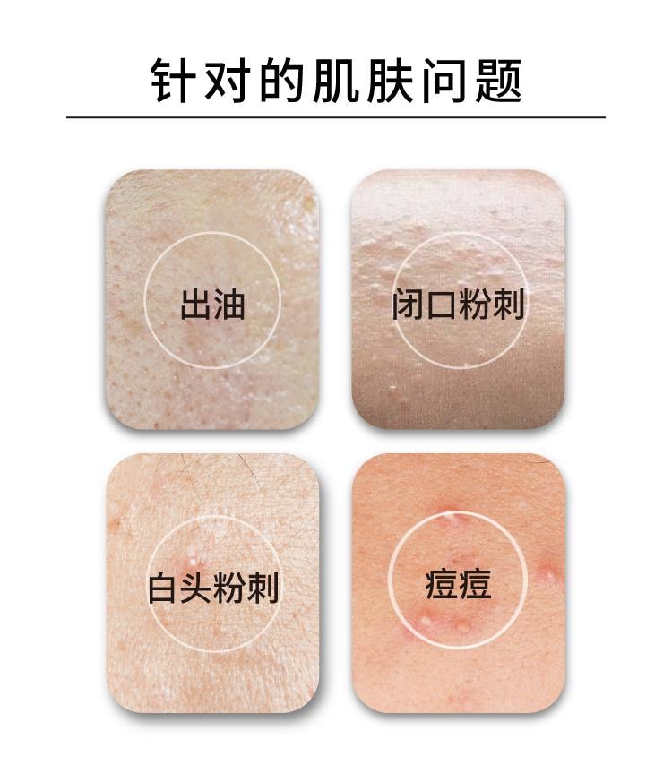 【中國直郵】 John Jeff 20%壬二酸霜15g 快速祛痘 卓效控油