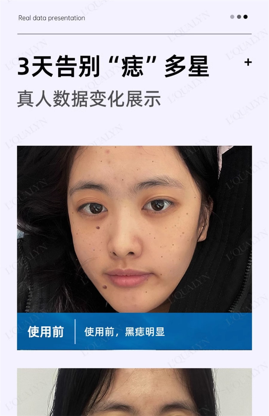 【中国直邮】欧泉琳 点痣膏无痕脸部去痣淡斑神器点痣笔非药水点斑美容专用 5g/瓶+5ml/瓶