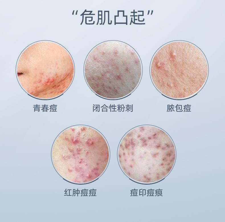 【中國直郵】 軍獻 精華祛痘膏25g 去閉口粉刺紅腫油痘肌