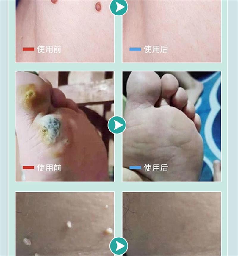  祥医堂 脖子肉粒丝状扁平疣去疣不留根 嘧腚抑菌克疣膏20g