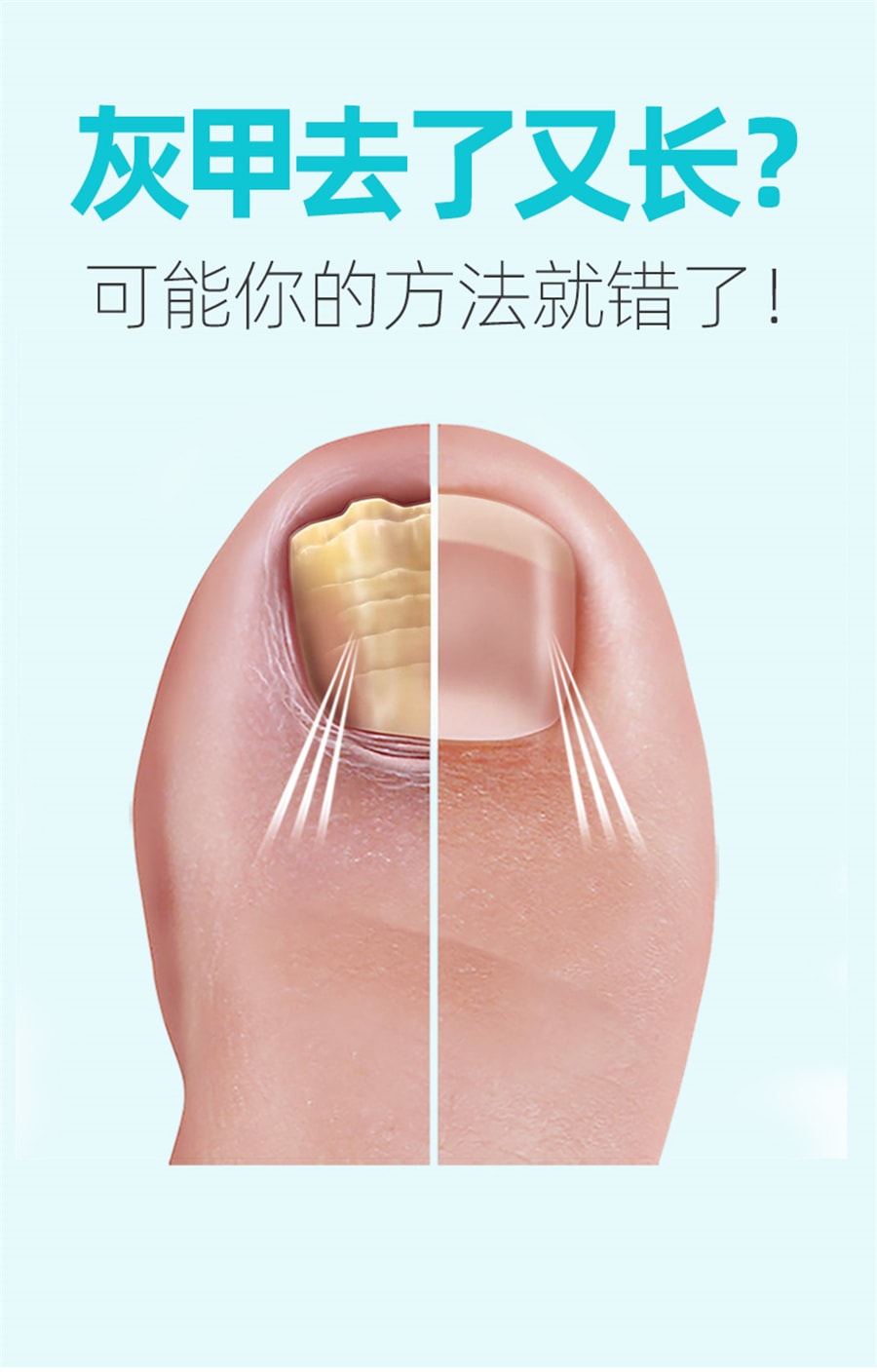 【中国直邮】脚医生   甲卫士灰指甲专用液治療冰醋酸  4m/瓶